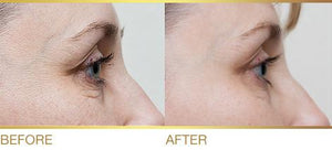 0103 Pier Auge - Cryo-Restructurel Face Lift Treatment - The Ultimate Anti-Aging Program